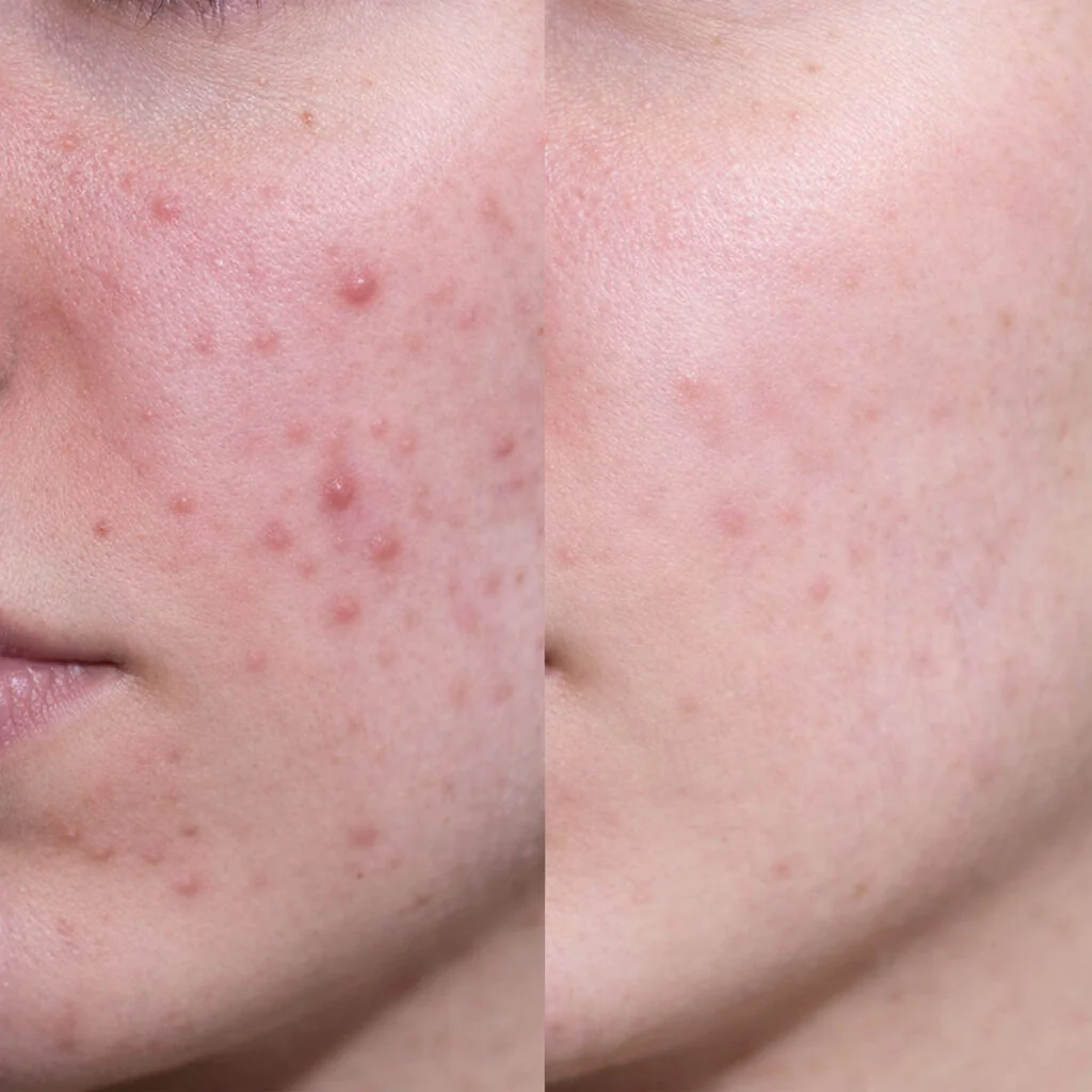 Salicylic Acid Face Cream for blemishes, blackheads and pimples — Lightweight, non-greasy & non-comedogenic moisturiser for oily & acne-prone skin that unclogs pores and locks in moisture. - Image 6