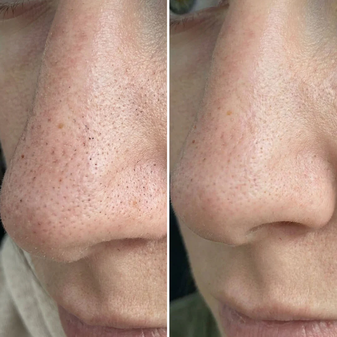 Blackhead & Pore Kit – Deep Cleansing Salicylic Acid — Kit for clogged pores and impurities. Cleanse and hydrate for a flawless finish. Contains effective Salicylic Acid for deep results. - Image 6