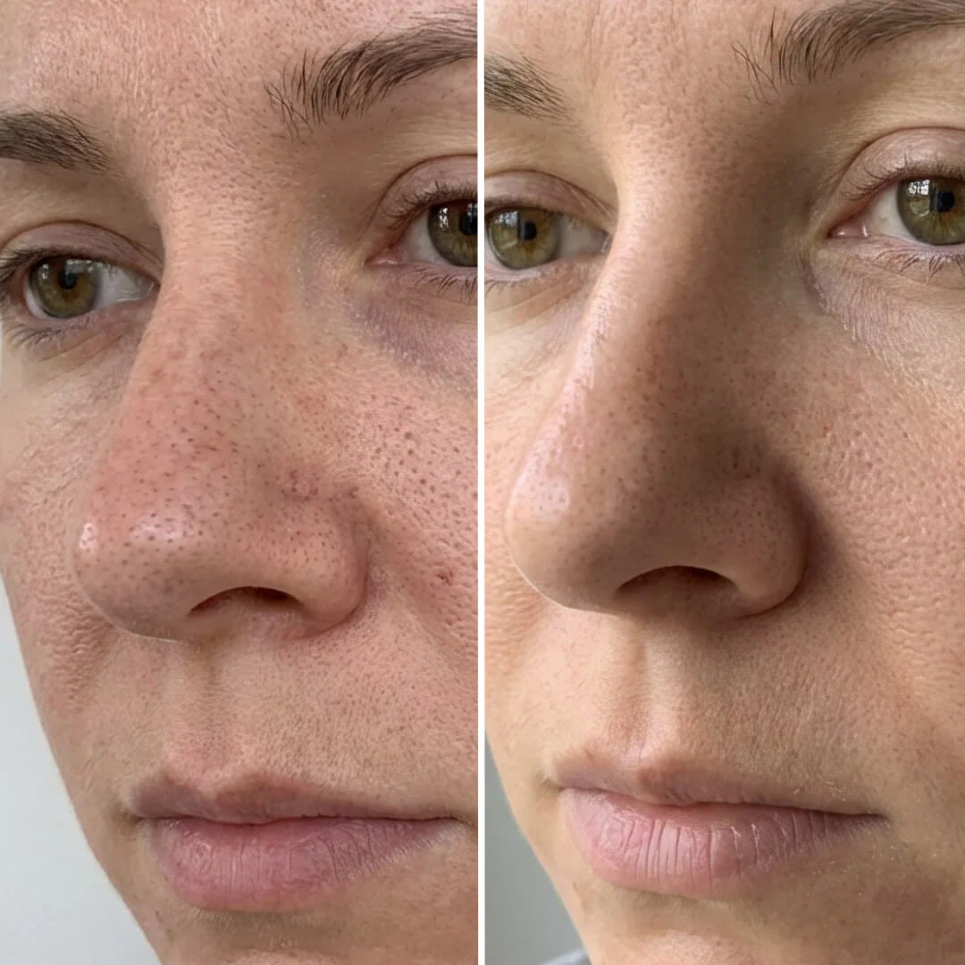 Blackhead & Pore Kit – Deep Cleansing Salicylic Acid — Kit for clogged pores and impurities. Cleanse and hydrate for a flawless finish. Contains effective Salicylic Acid for deep results. - Image 7