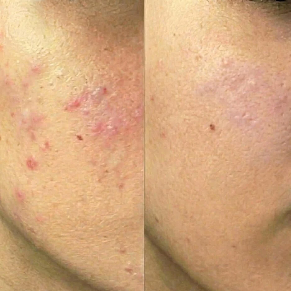 Salicylic Acid SOS Stick for blemishes and clogged pores — Salicylic Acid SOS Stick targets oily skin and impurities. Calms, clears, and restores balance. Contains Salicylic Acid. - Image 6